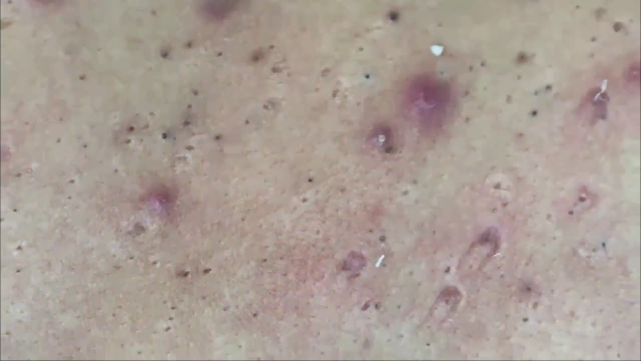 Back Treatment Blackhead extractions YouTube