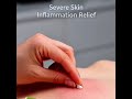 Dermovate Cream (Clobetasol 0.05%) is a very strong topical corticosteroid used for severe inflammat