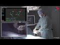 Machine vision  the new navigation for spine surgery