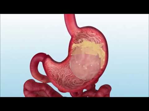 INFLATION OF THE INTRAGASTRIC BALLOON