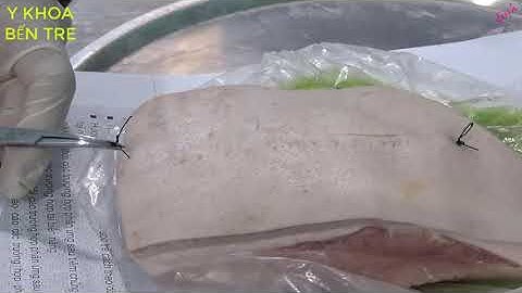 Kỹ thuật cắt chỉ vết thương mũi khâu trong da không giấu chỉ