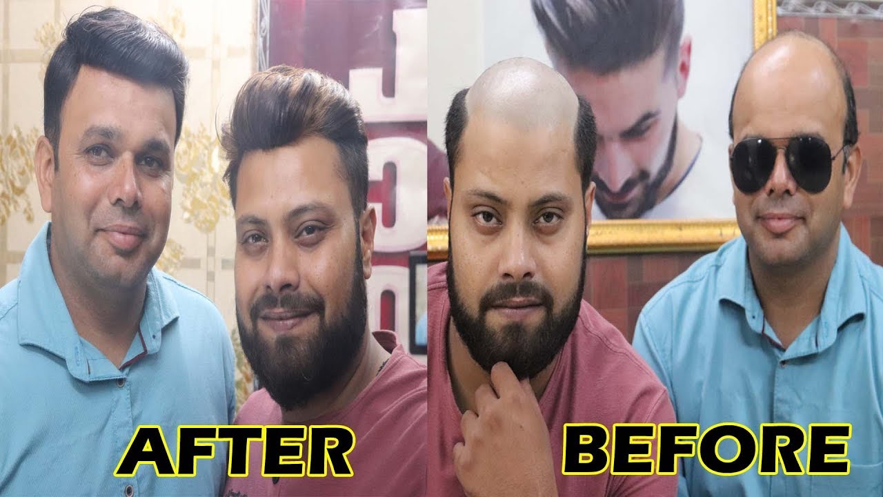 Non Surgical Hair Replacement In Natural Hair Fixing System By