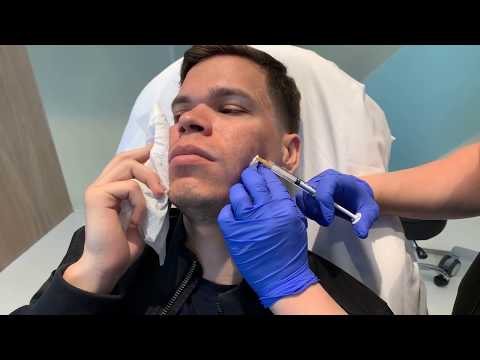 Bellafill Injections | Acne Scars | West Hollywood, CA | Dr. Jason Emer