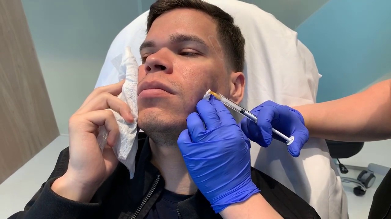Bellafill Ab Injection Bellafill Injections | Acne Scars | West Hollywood, CA | Dr. Jason Emer ...