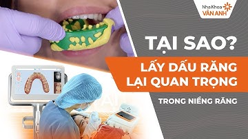 Tại sao lấy dấu răng quan trọng trong niềng răng