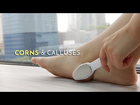 Video: Hvordan Bli Kvitt Calluses Raskt Hjemme? 5 Effektive Metoder