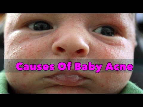 Causes Of Baby Acne- SheCare