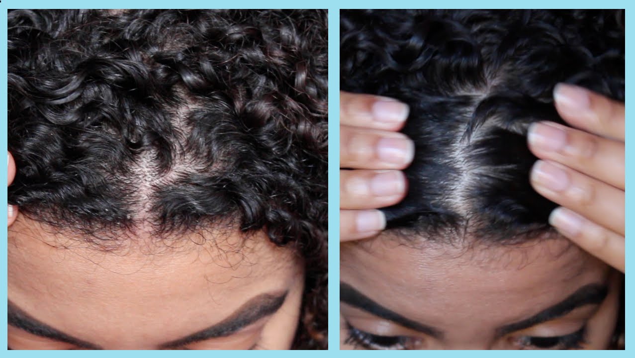 How To Remove Dandruff With Apple Cider Vinegar Natural Curly