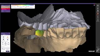 Exocad para PRINCIPIANTES // Diseño de corona monolítica sobre escaneado intra oral