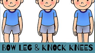 Bow leg and Knock Knees in Children, when is it normal, and when should we consult our Pediatrician?