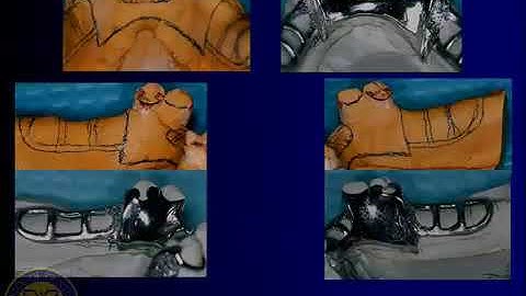 DENT 718  Combination cases  complete and partial denture sets