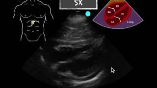 POCUS Teaching Point Pericardial effusion