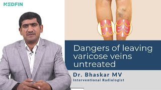 Risks and dangers of leaving Varicose Veins untreated