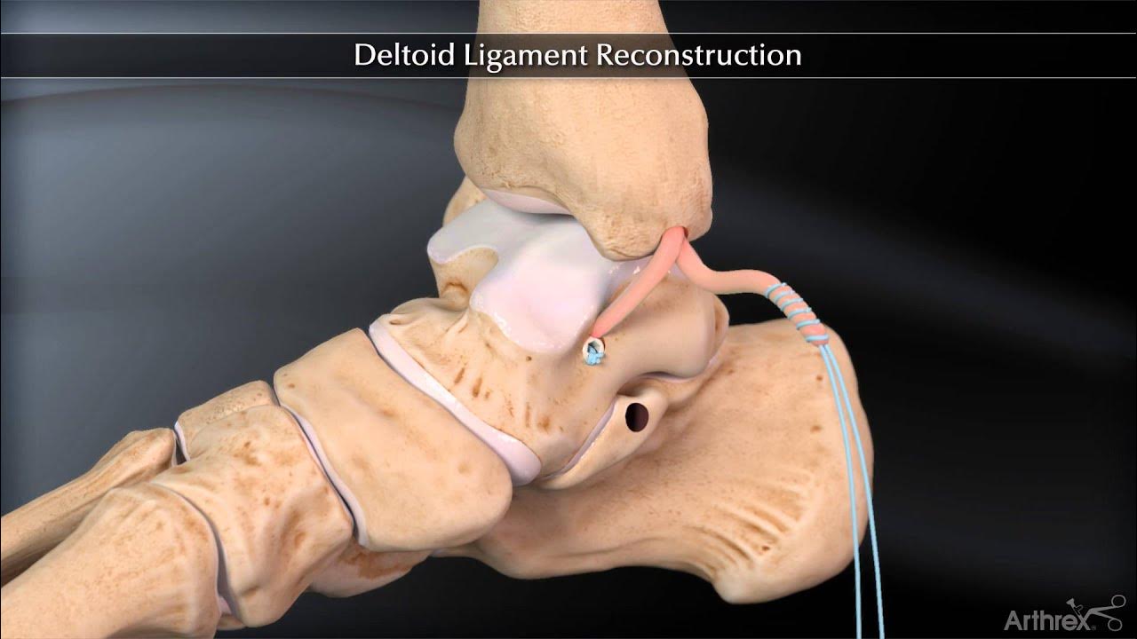 Deltoid Ligament Reconstruction 