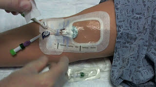 PICC Line Dressing Change with SorbaView Shield Dressing and BioPatch Disk
