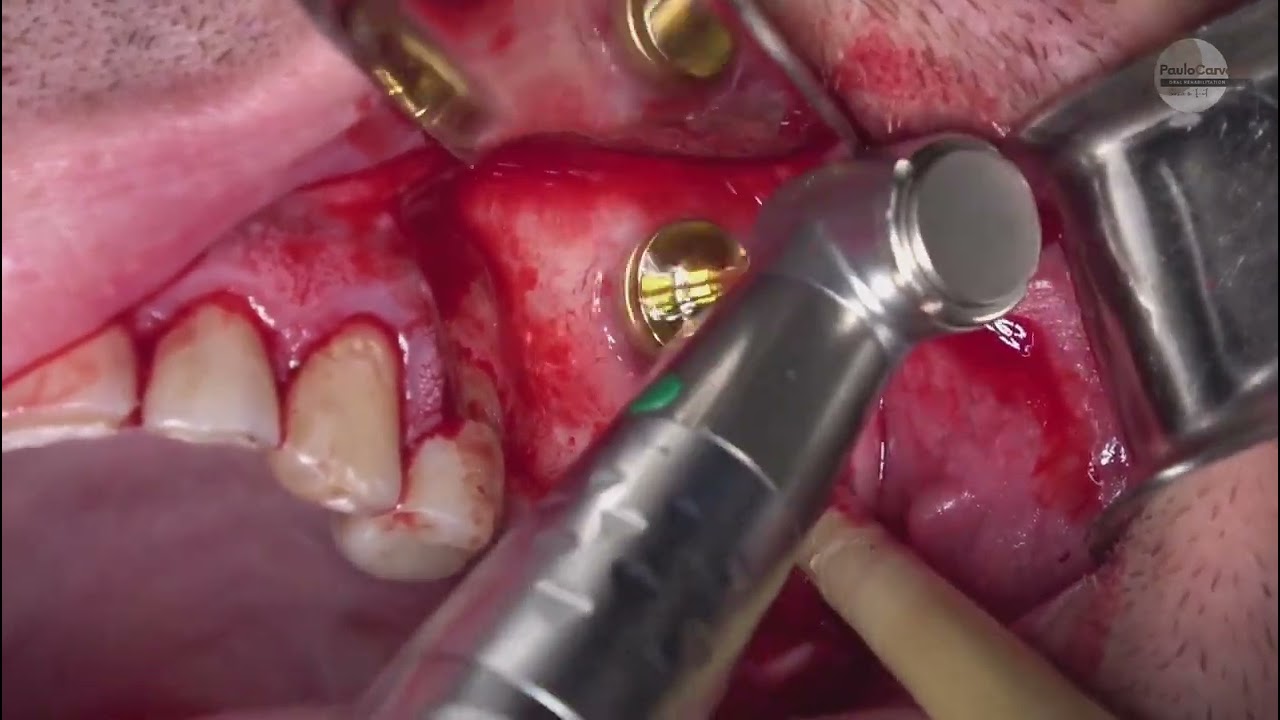 Our Lusobionic Ambassador Dr. Paulo Carvalho using the DASK system by Dentium.