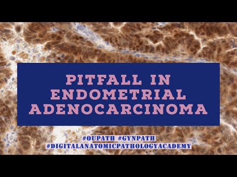 Pitfall in Diagnosis of Endometrial Adenocarcinomas