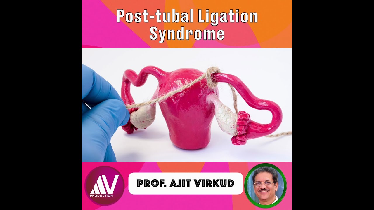 Patss Post Tubal Ligation Syndrome: Does it exist? - YouTube