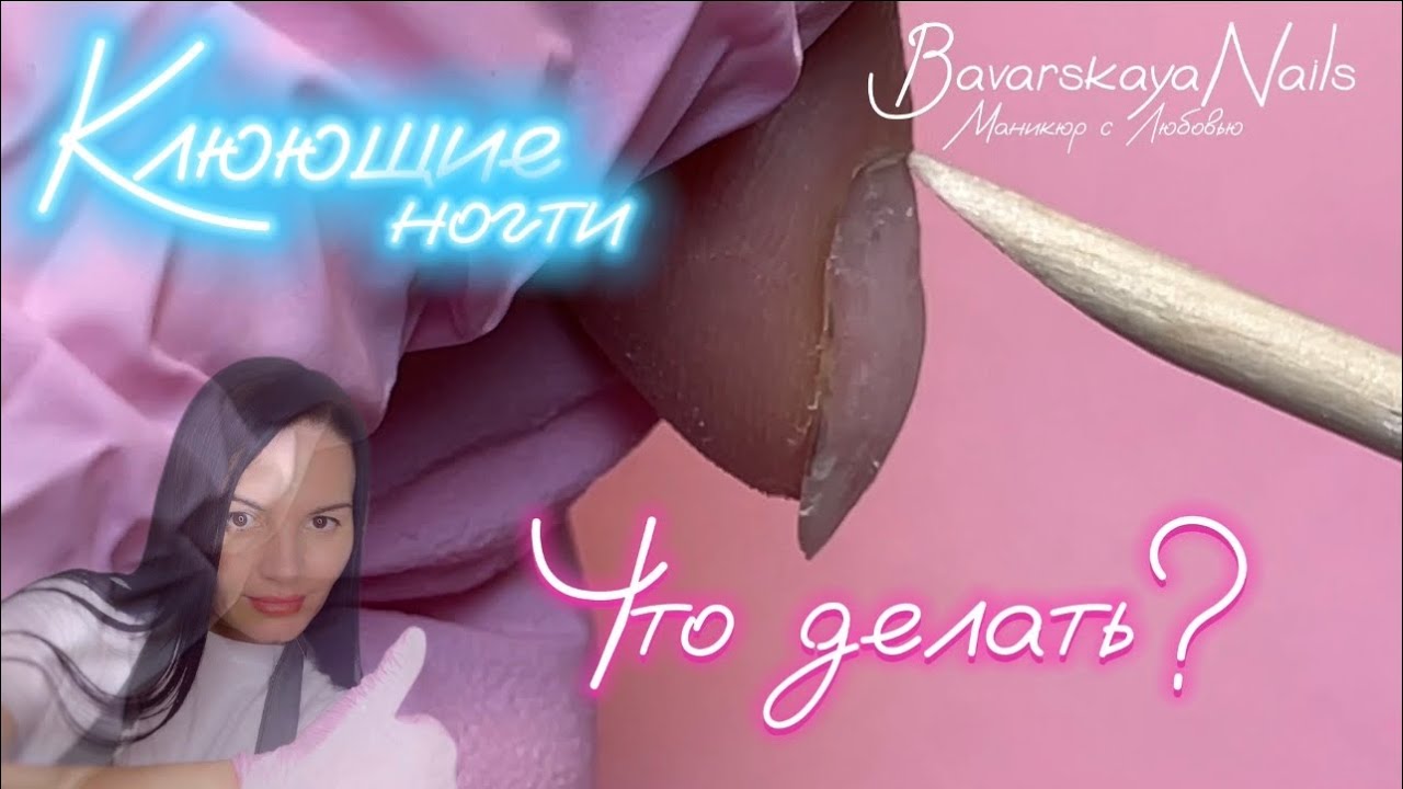 Клюющие ногти.Поднятие клюющих ногтей полигелем