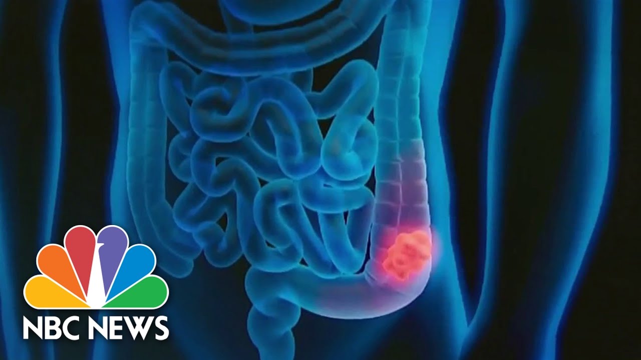 Report says more younger people are being diagnosed with colorectal cancer