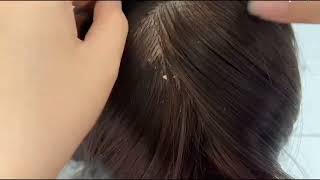 ASMR Big Flakes Dandruff & Head Lice Removal | Satisfying Scalp Treatment