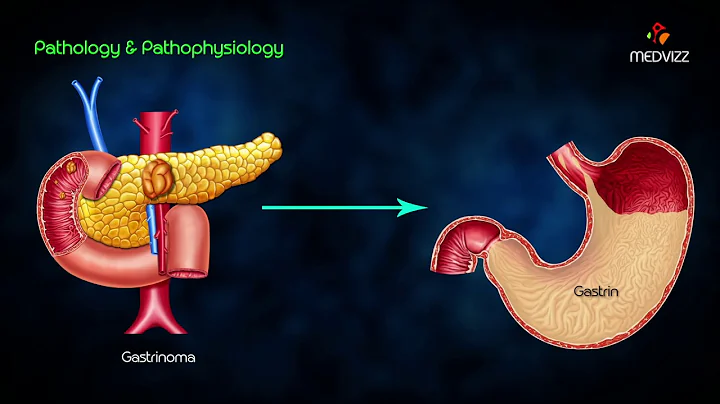 Zollinger-Elliso...  syndrome (ZES) - Animated lec...