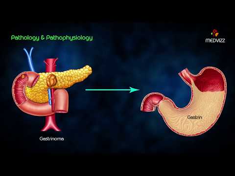 Zollinger-Ellison syndrome (ZES) - Animated lecture usmle step 1 pathology , Dr Bhanu prakash