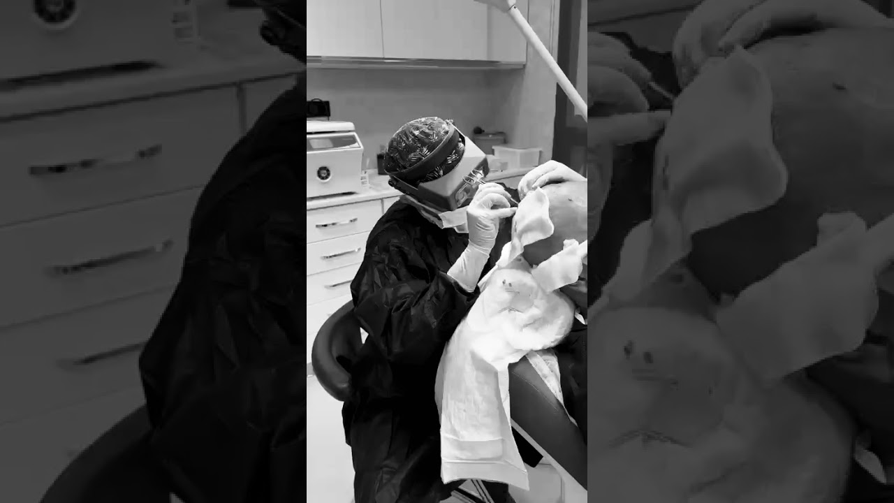 Как се отварят каналите при присаждане на коса? Вижте техниката на Д-р Демир!