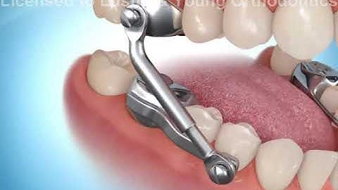 Herbst Appliance Orthodontic Overbite Corrector| Lustig & Young Orthodontics| Invisalign & braces TX