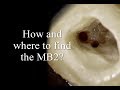 How and where to find the MB2 canals?