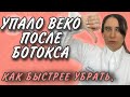 УПАЛО ОПУСТИЛОСЬ ВЕКО ПОСЛЕ БОТОКСА/УПАЛИ БРОВИ/ИСТИННЫЙ ПТОЗ/ОСЛОЖНЕНИЯ БОТОКС.