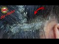 Dandruff Scratching