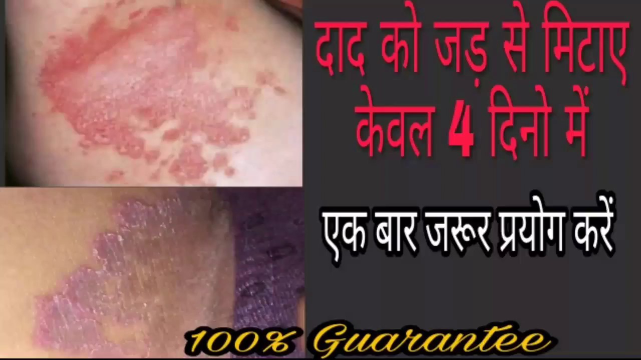 दाग दूर करने के घरेलू उपचार। home remedies for ringworm/Daad ka illaj