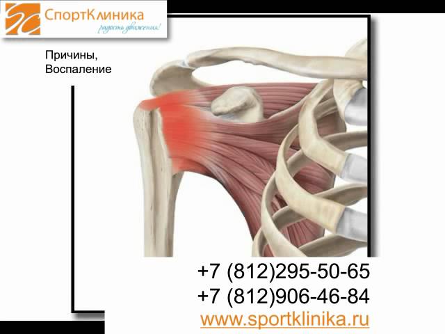 Импиджмент синдром. Видео 1 - СпортКлиника