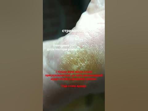 стрижнева мозоль стрижевий СТЕРЖНЕВОЙ стержень стрижень - YouTube