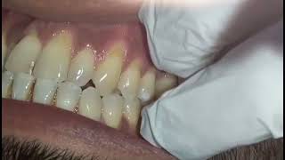 TOOTH BRUSH ABRASION  | aggressive tooth brushing | Tooth structure loss