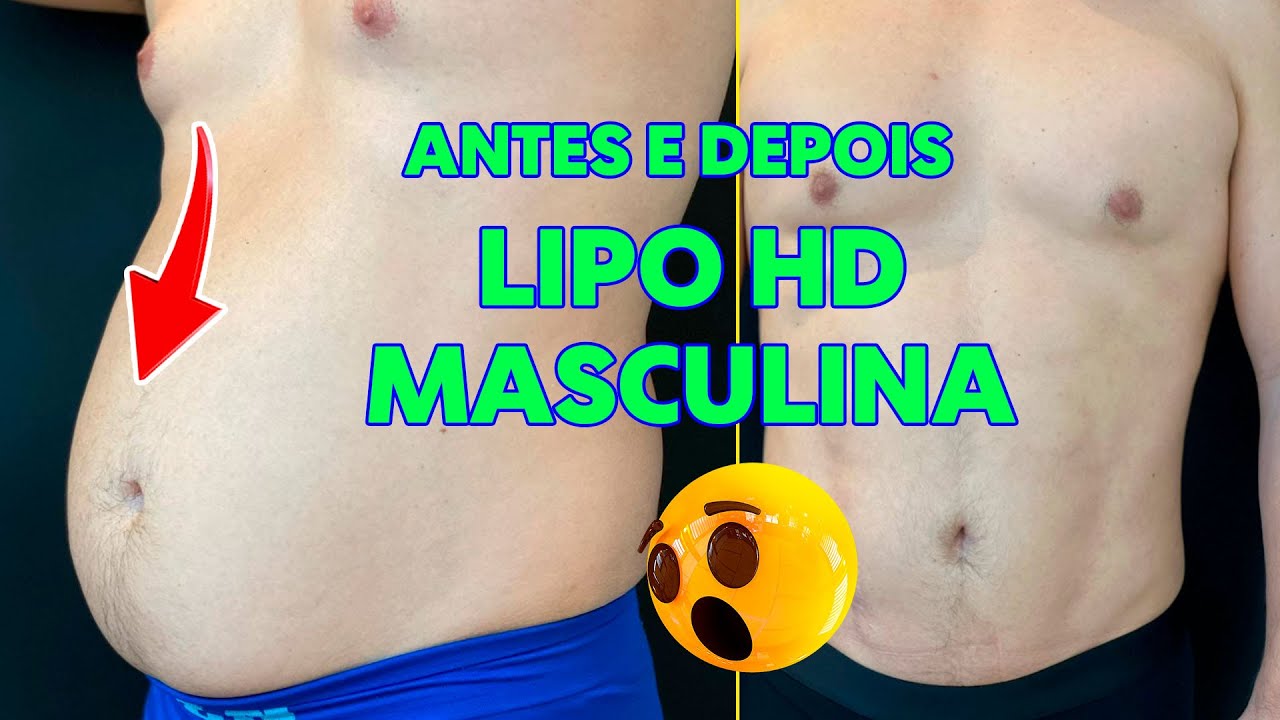 ANTES E DEPOIS LIPO HD MASCULINA - YouTube