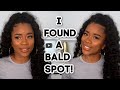 I Had A Bald Spot! Here's How I Grew My Hair Back