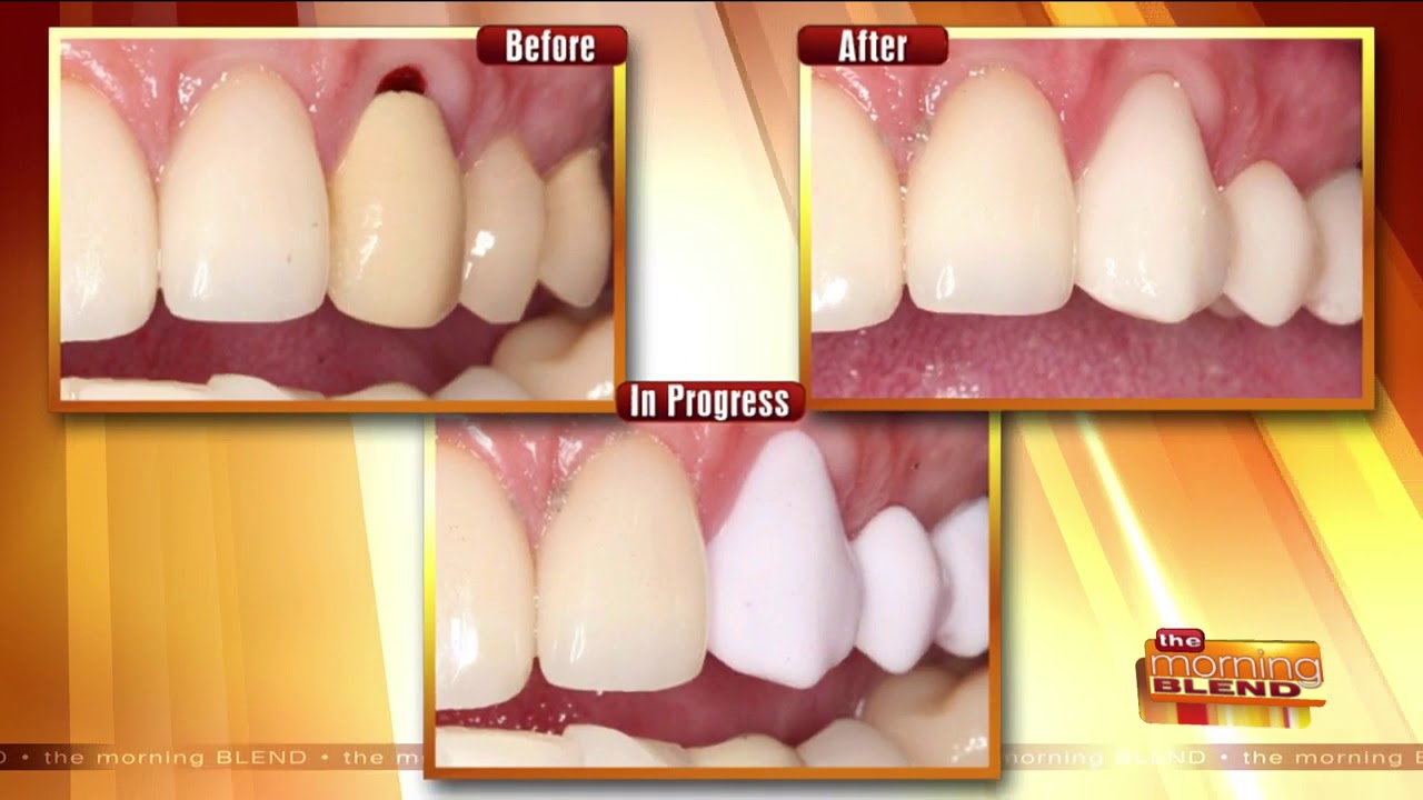 Get New Dental Crowns in Just an Hour YouTube