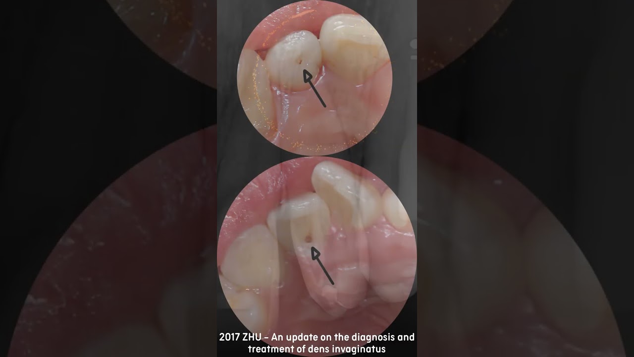 Dens invaginatus (dens-in-dente)