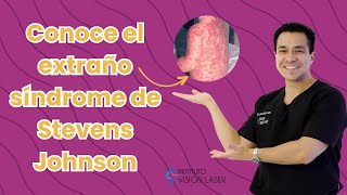 Síndrome de Stevens Johnson ¿conoces esta rara enfermedad?