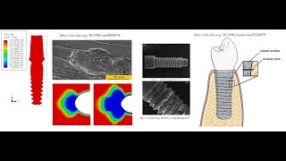 Modelling corrosion in Dental implant using UEL subroutine in Abaqus