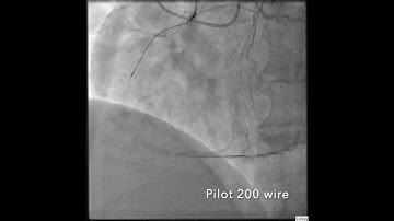 Right coronary artery complex CTO PCI via AWE technique