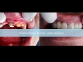 Odontologia Medellin Reconstrucción Dental Mejor Puente Fijo