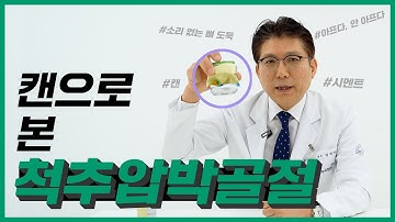 척추압박골절의 모든 것, ‘콕’ 집어드립니다! (원인, 증상, 치료, 수술)