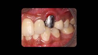 cast post and core#endo #postcore#castpost#pfm#dmls