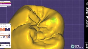 exocad design(upper first molar)
