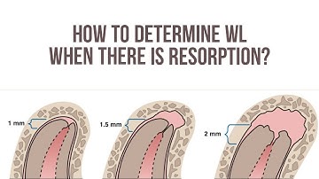 Working Length Determination | Weine Method | Major and Minor Diameter | Dr Bhaumik Joshi
