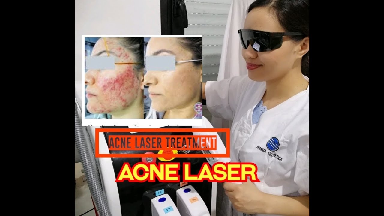 Acne Laser Treatment YouTube