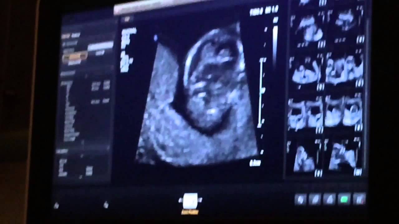 Baby Scan its a girl! YouTube
